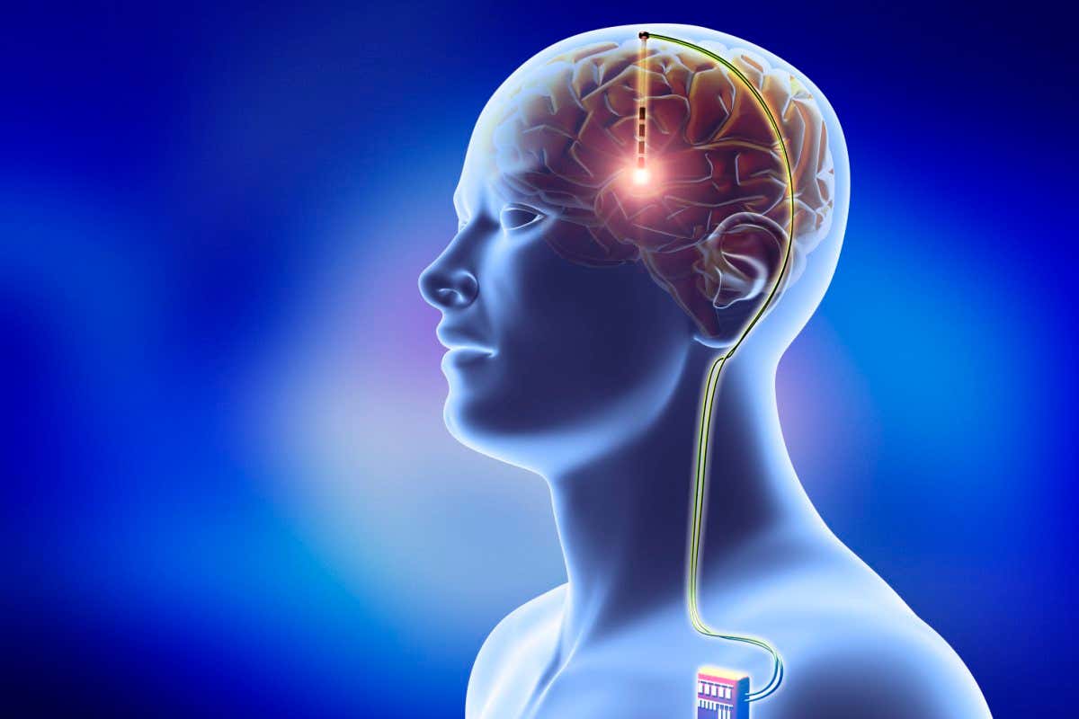Deep brain stimulation involves implanting electrodes in the cerebral lobes of the brain, linked through the scalp to wires that lead to a battery implanted below the skin that send electrical impulses to specific areas of the brain