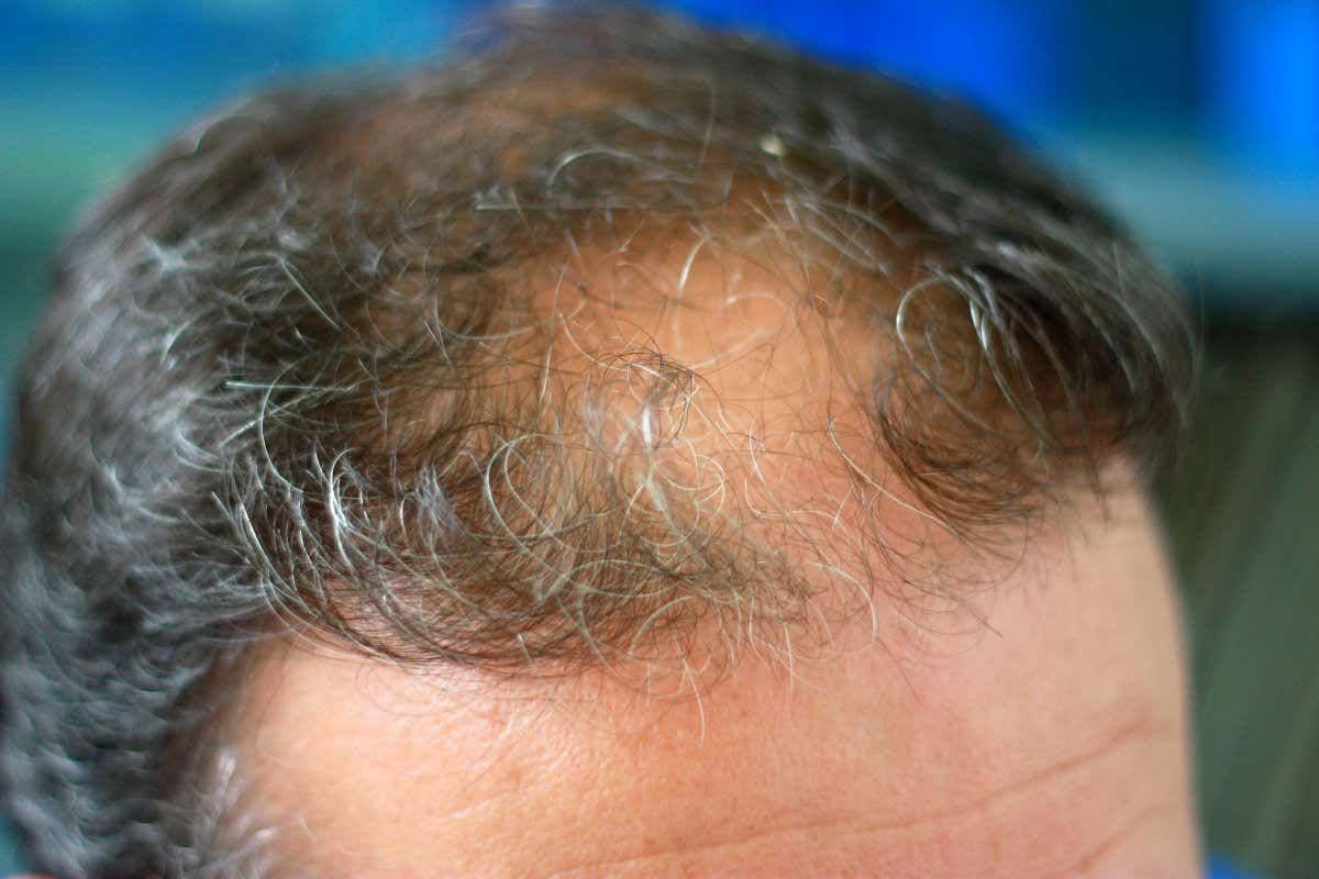 Hair loss may be a long covid symptom