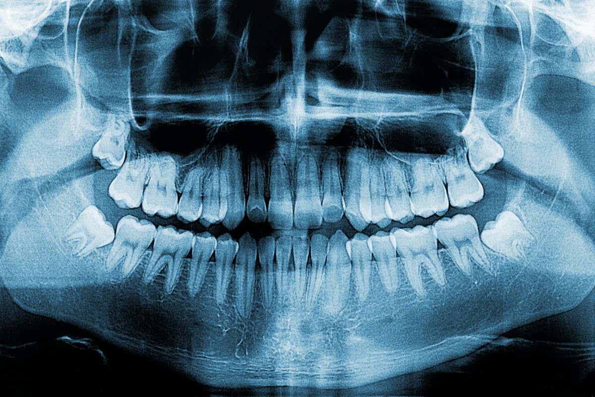 Dental X-ray