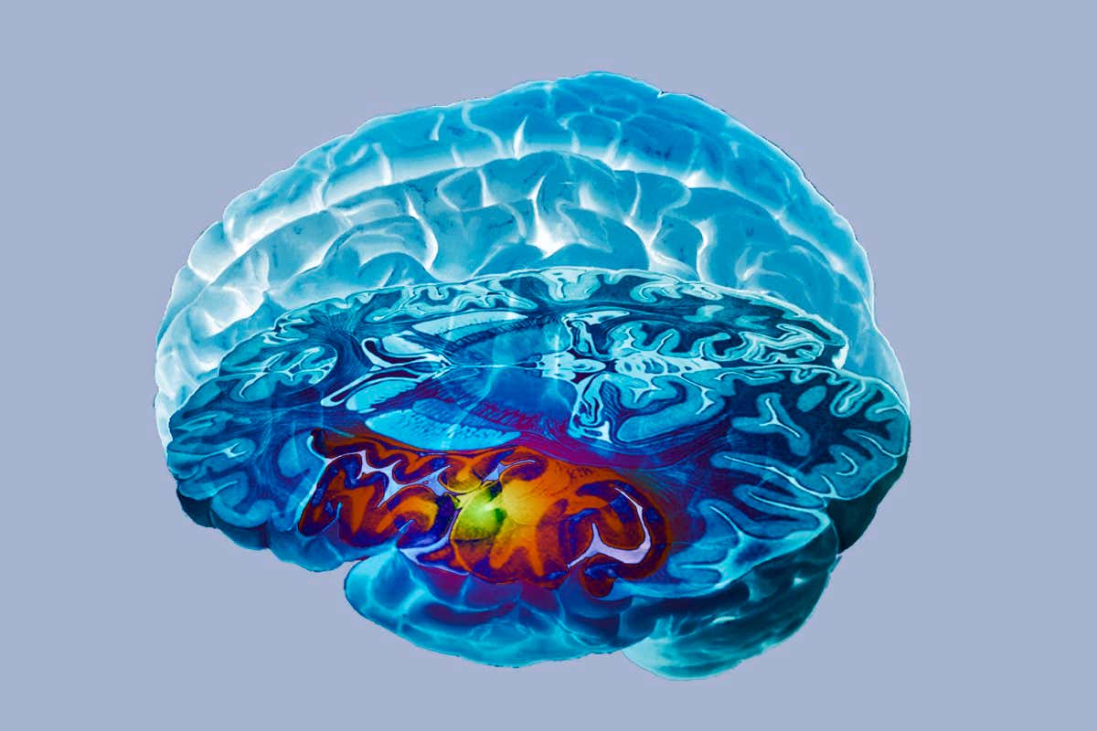 A 3D magnetic resonance imaging (MRI) scan of the brain of a 65-year-old after a stroke. The orange coloring represents an area of dead tissue
