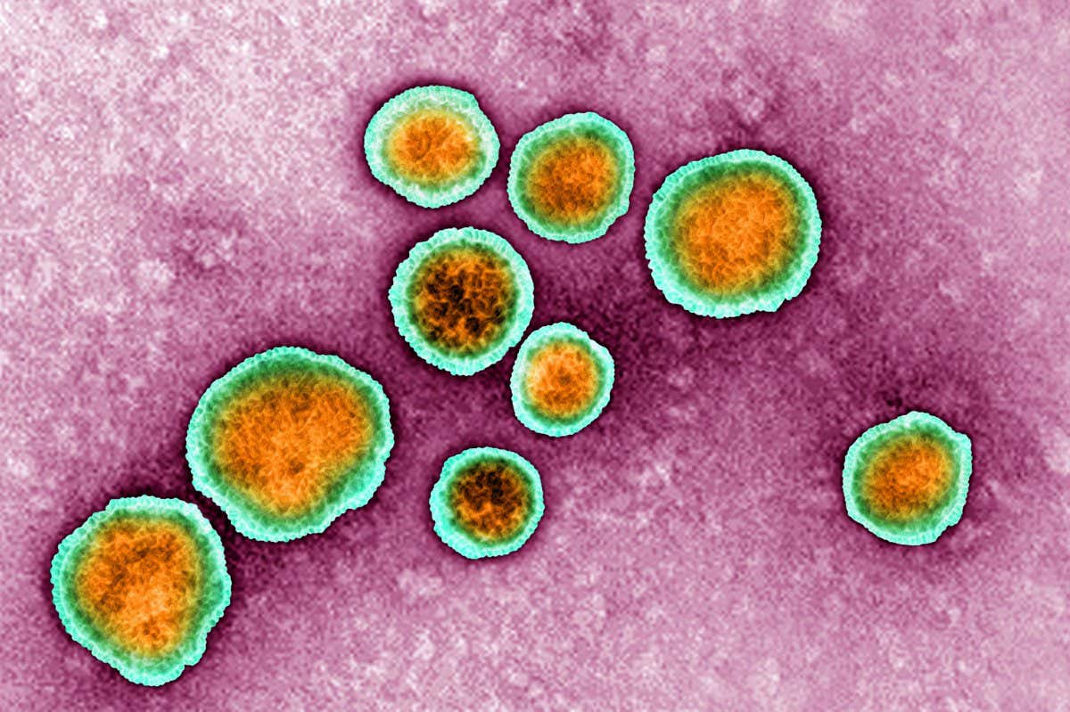 Bronchiolitis is most commonly caused by the respiratory syncytial virus (RSV)