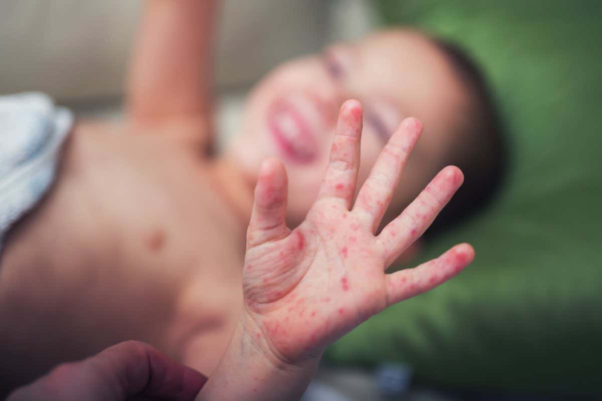 A child with symptoms of hand, foot and mouth disease