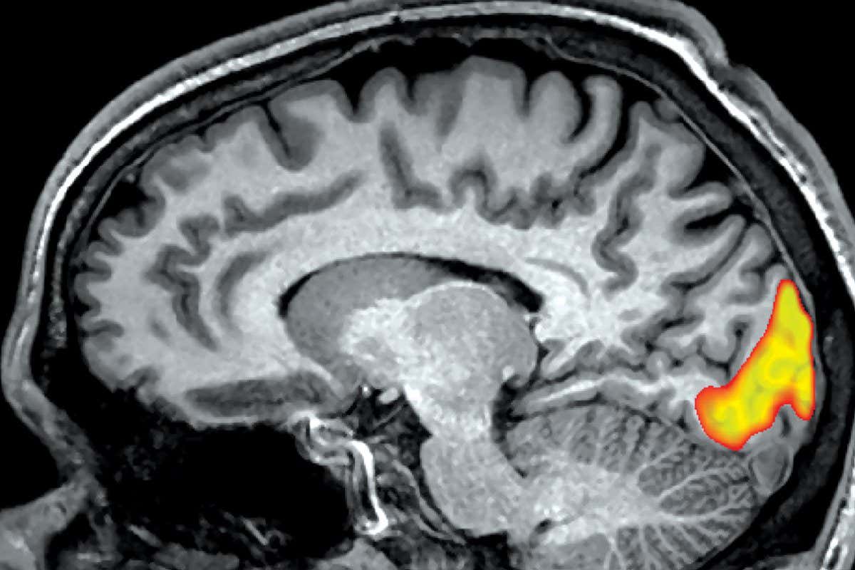 A functional MRI scan showing stimulation in the brain