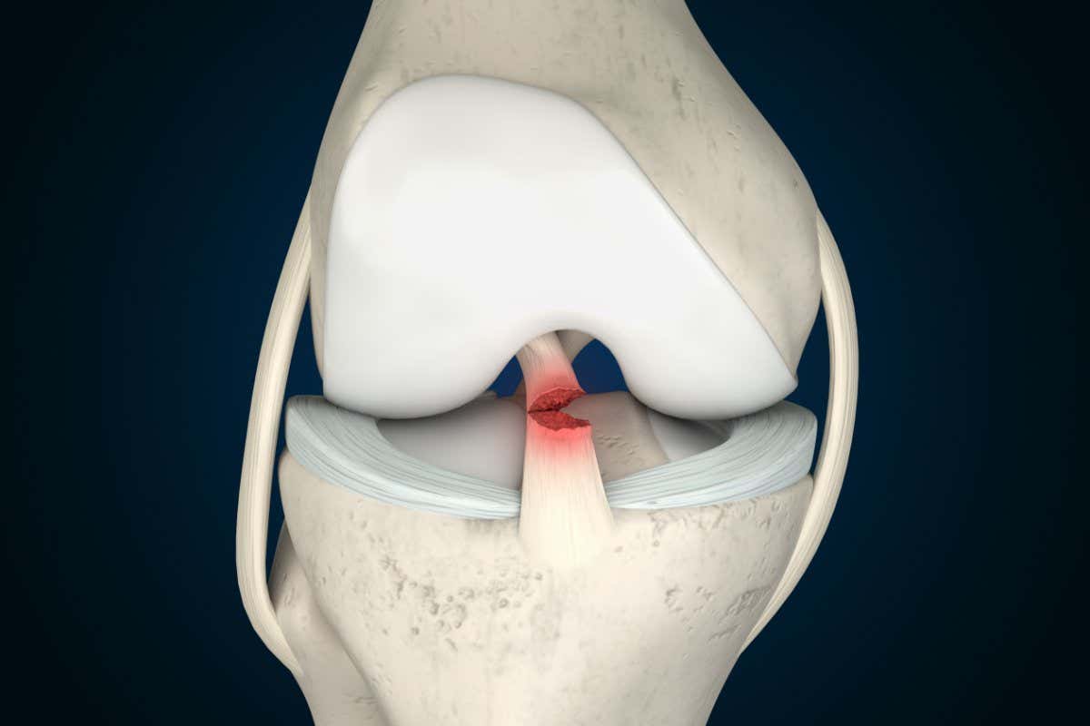 Illustration of a tear in an anterior cruciate ligament