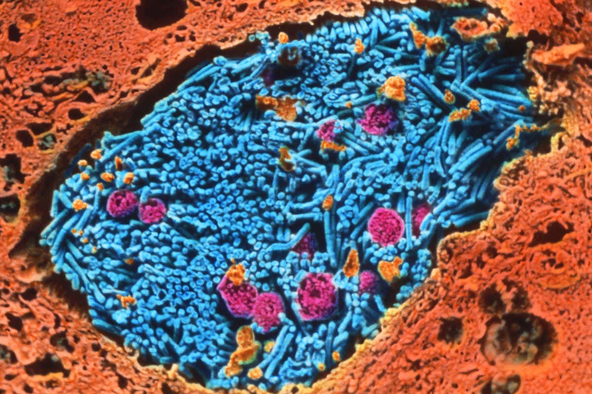 Anthrax bacteria in lung. Coloured scanning electron micrograph (SEM) of a cluster of anthrax bacteria (Bacillus anthracis) in a capillary of the lung. These rod-shaped, Gram-positive bacteria are highly pathogenic. Commonly an infection of livestock, B. anthracis is transmitted to humans by contact with contaminated animal hair, hides or excrement. Two forms of the disease occur: pneumonia in the lungs (woolsorter's disease), and cutaneous anthrax, which causes a large boil at the site of the bacteria's entry. Antibiotic treatment, if prompt, may be effective for the skin infection. Pulmonary anthrax is fatal in most cases. Magnification: x540 at 6x7cm size. x1750 at 7.5x9.5