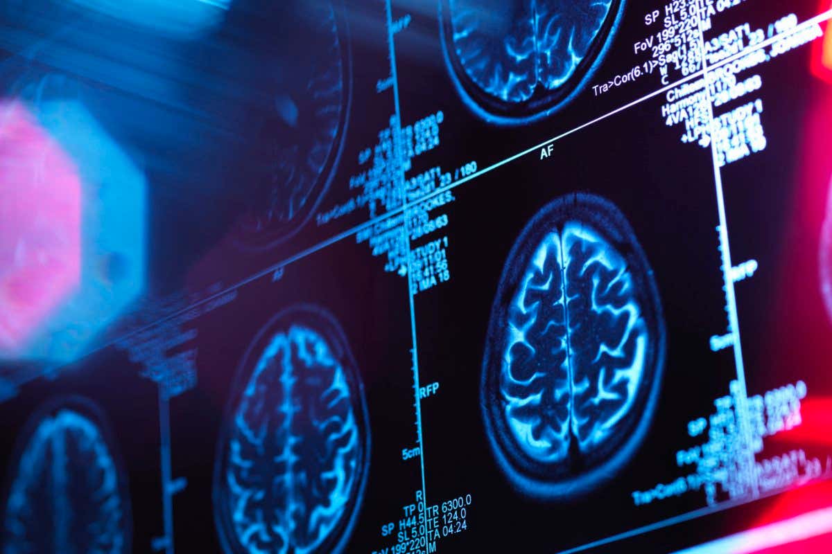 Alzheimer's may be caused by the accumulation of protein plaques and tangles in the brain