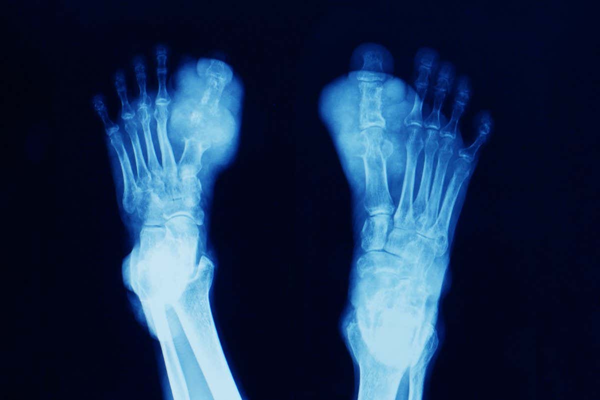 X-ray of feet affected by gout