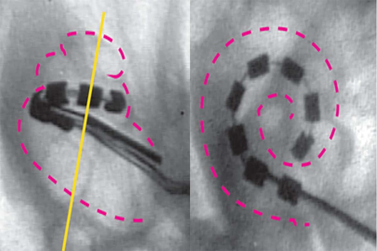 X-rays from different angles showing cochlear implants in a rat