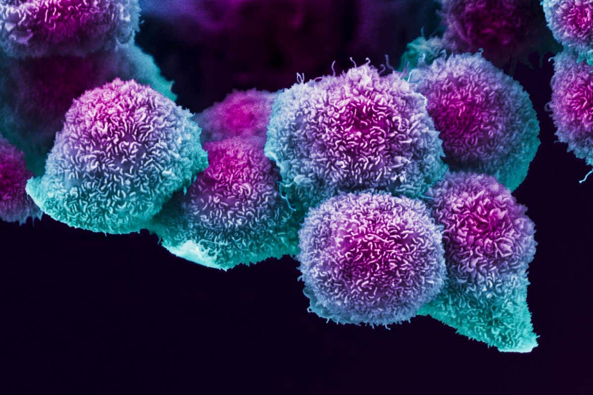Pancreatic cancer cells captured via a coloured scanning electron micrograph
