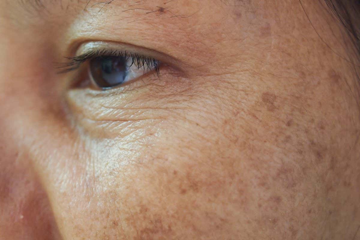 Closeup dark spots melasma pigmentation skin on face asian woman. Problem skincare and health concept.