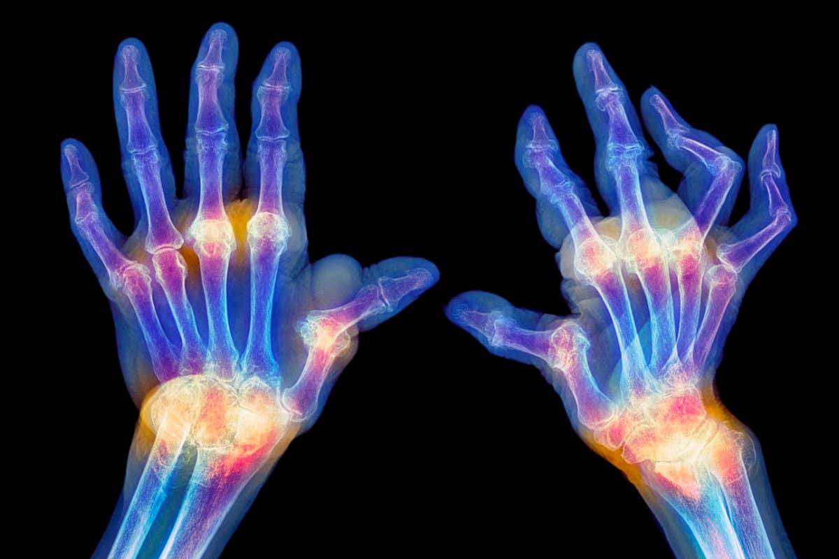 Rheumatoid arthritis of the hands. Coloured bilateral X-ray of the hands and wrists of a patient with rheumatoid arthritis. The arthritis is particularly severe in the hand at right, with several joint deformities. Rheumatoid arthritis is a degenerative autoimmune disease that mainly affects the capsule (synovium) around the synovial (flexible) joints, causing chronic inflammation. It can be a debilitating and painful condition and can lead to deformities and loss of functioning and mobility.