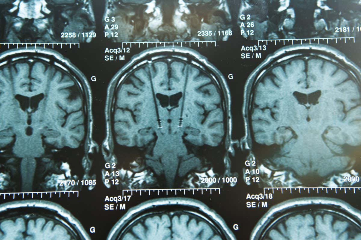 Deep brain stimulation