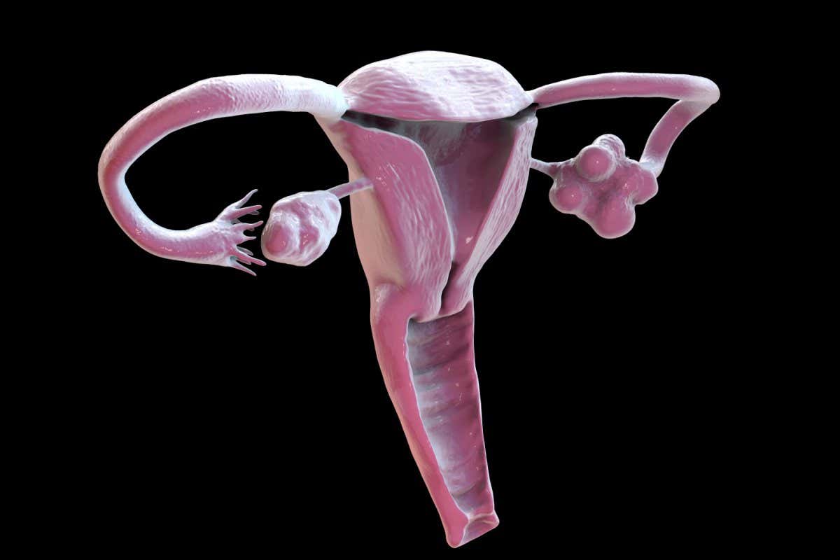 Polycystic ovary syndrome, 3D illustration showing healthy ovary (right) and enlarged ovary with cysts (left); Shutterstock ID 2031203066; purchase_order: -; job: -; client: -; other: -