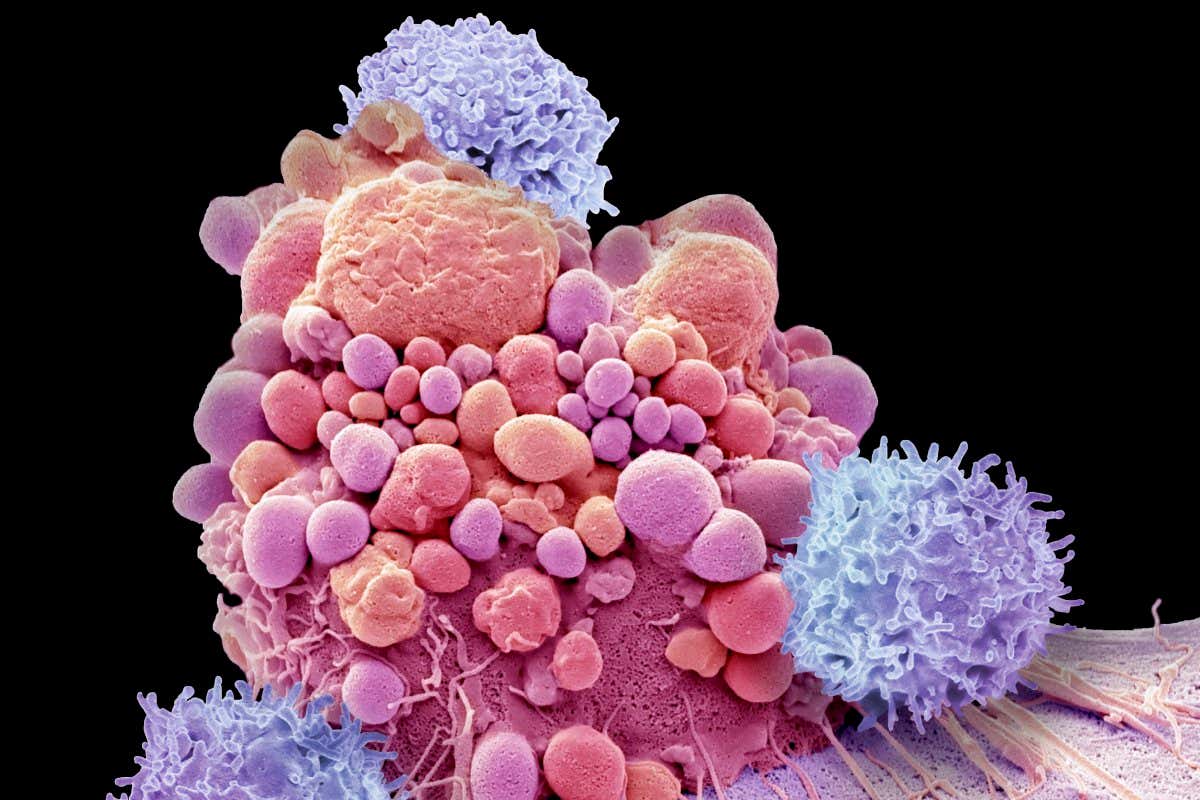 T-cells and brain cancer cell. Composite coloured scanning electron micrograph (SEM) of T-cells and an apoptotic brain cancer cell. T-cells are a component of the body's immune system. CAR T-cell therapy takes T-cells from a cancer patient's blood and modifies them to recognize a specific protein found on patient's tumor cells. When reintroduced to the patient the T-cells find and destroy the tumour cells. The newest form of CAR T-cell therapy, now in clinical trials, uses 'memory' T-cells which remain in the body after attacking the cancer. The hope is that memory T-cells may provide an active reservoir of cancer-killing cells capable of stopping further tumours. Magnification: x6000 at 10cm wide.