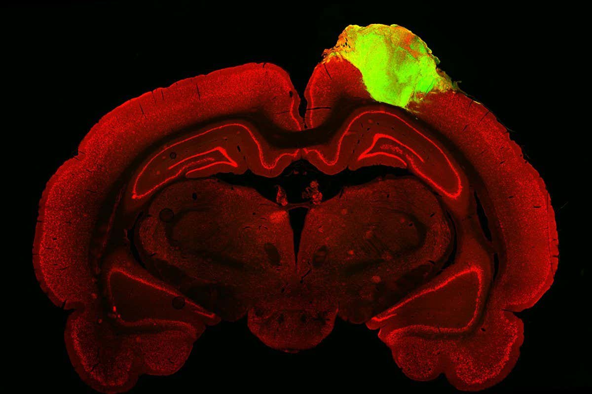 A rat brain (red) with a grafted human brain organoid (green)