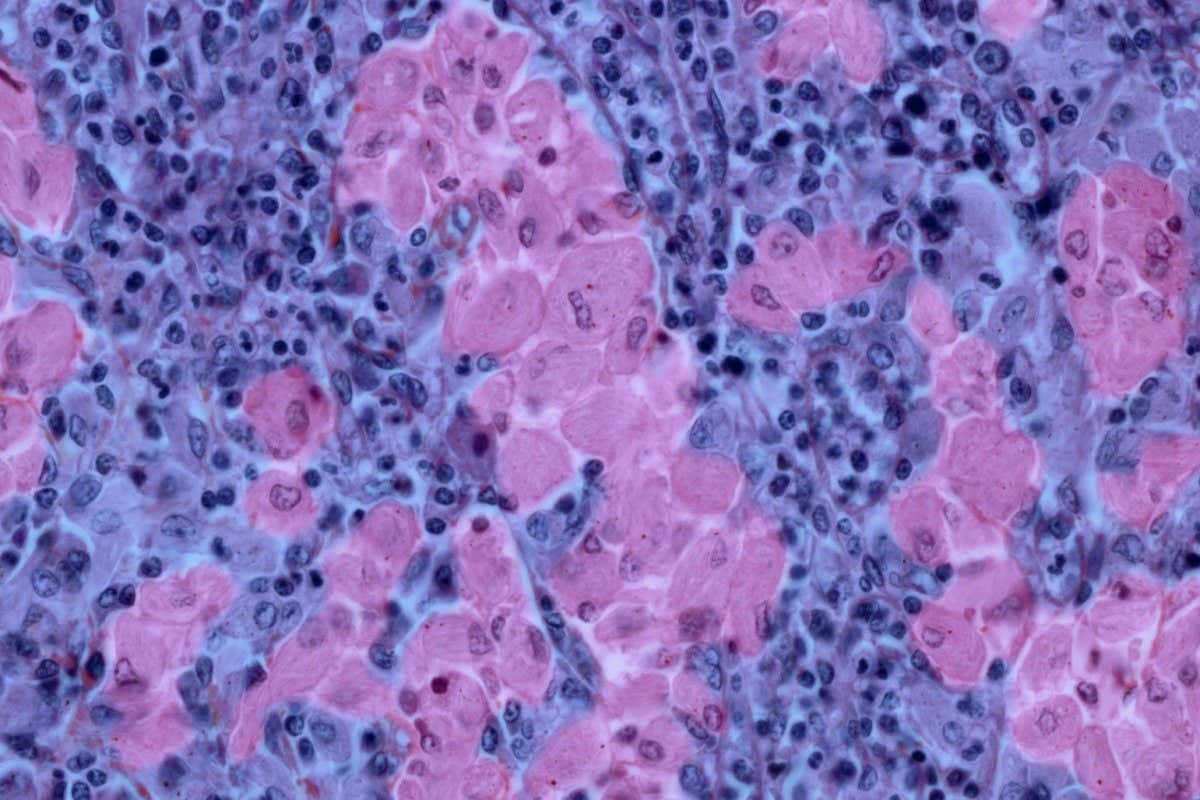 Light micrograph of a section through the spleen of a patient with Gaucher's disease. Small lymphocytes and large macrophage cells (Gaucher?s cells, pink, a type of white blood cell) are present. Gaucher's disease is an inherited metabolic disorder in which a fatty substance called glucocerebroside accumulates in the spleen (in macrophages), lungs, liver and bone marrow, and sometimes the brain. This is due to an absence of the enzyme glucocerebrosidase (GC). The disease appears in childhood, and some forms are fatal in the first few years. Other forms cause enlargement of the affected organs, weak and painful bones and anaemia. Some forms also cause severe nervous system damage. There is no cure, but enzyme replacement therapy using GC can relieve the symptoms. Haematoxylin-eosin saffron (HES) stain. Magnification: x400 at 24x36 mm size.