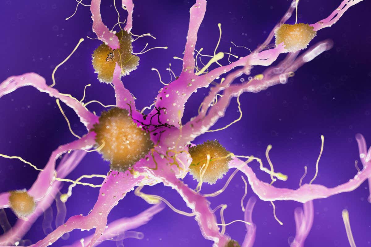 TXBTRF 3d rendered medically accurate illustration of amyloid plaques on a alzheimer nerve cell