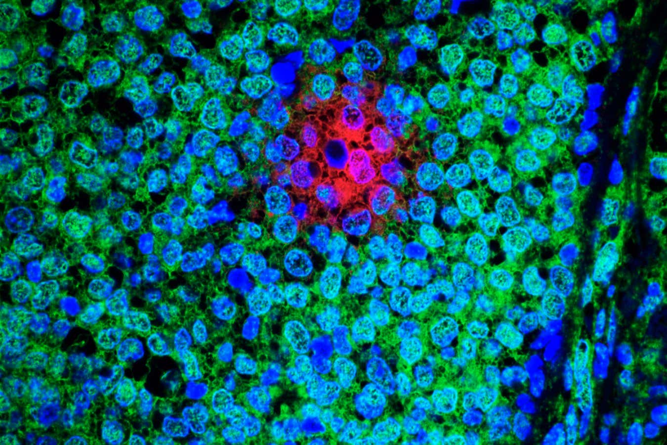 A micrograph of oestrogen-receptor positive breast cancer tissue, showing slowly dividing cancer cells (red) that resist treatment, the cells' nuclei in blue and rapidly dividing cancer cells in green