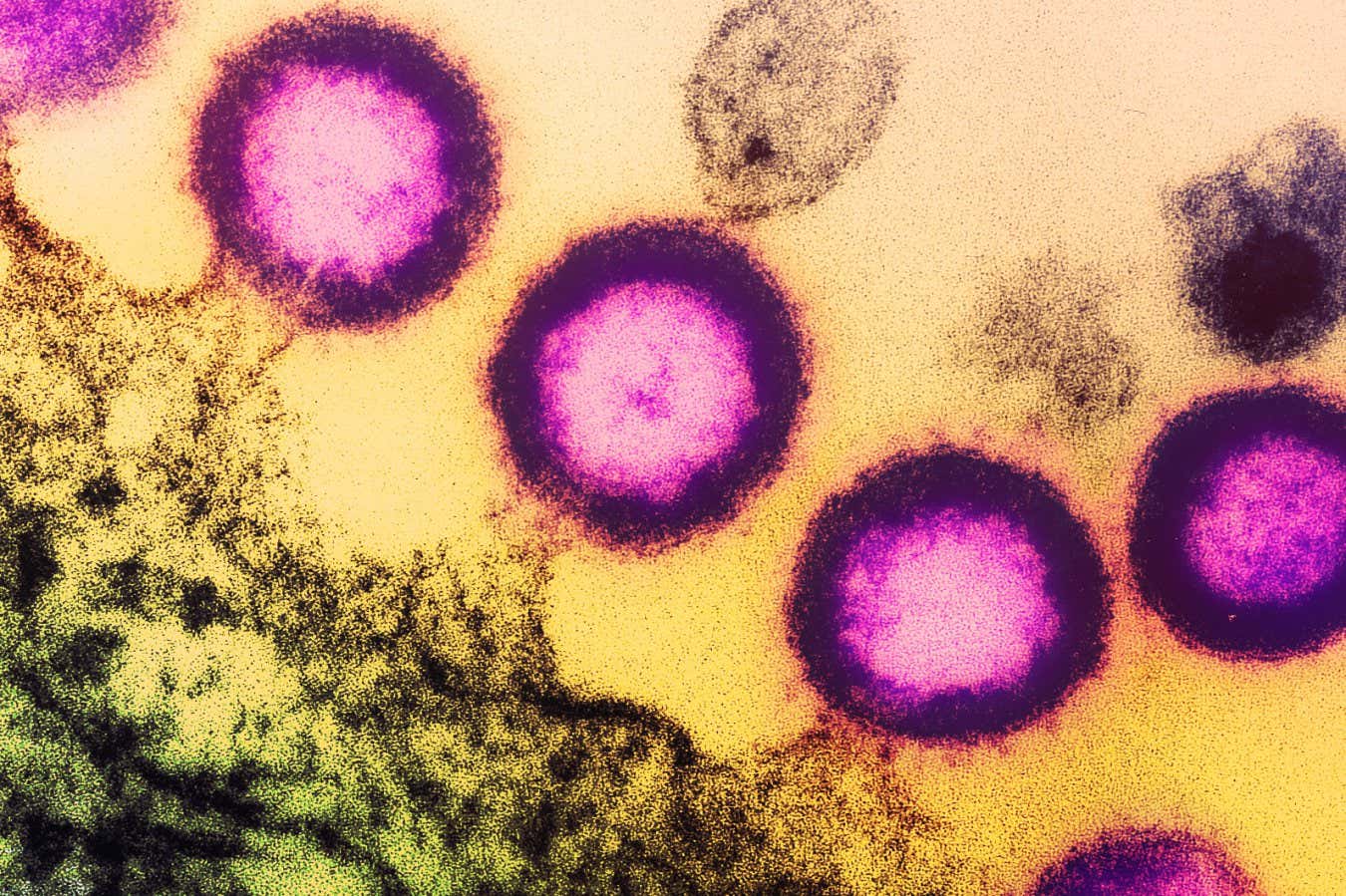 A transmission electron micrograph of HIV virus particles (pink) replicating from the plasma membrane of an infected immune cell