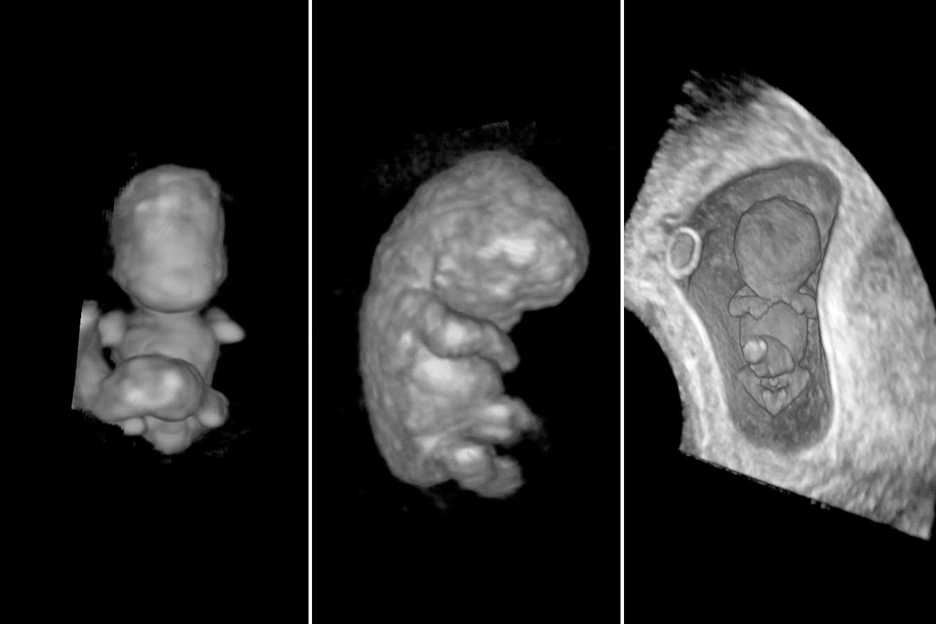 An embryo developing in the uterus at 8 weeks, 9 weeks and 10 weeks