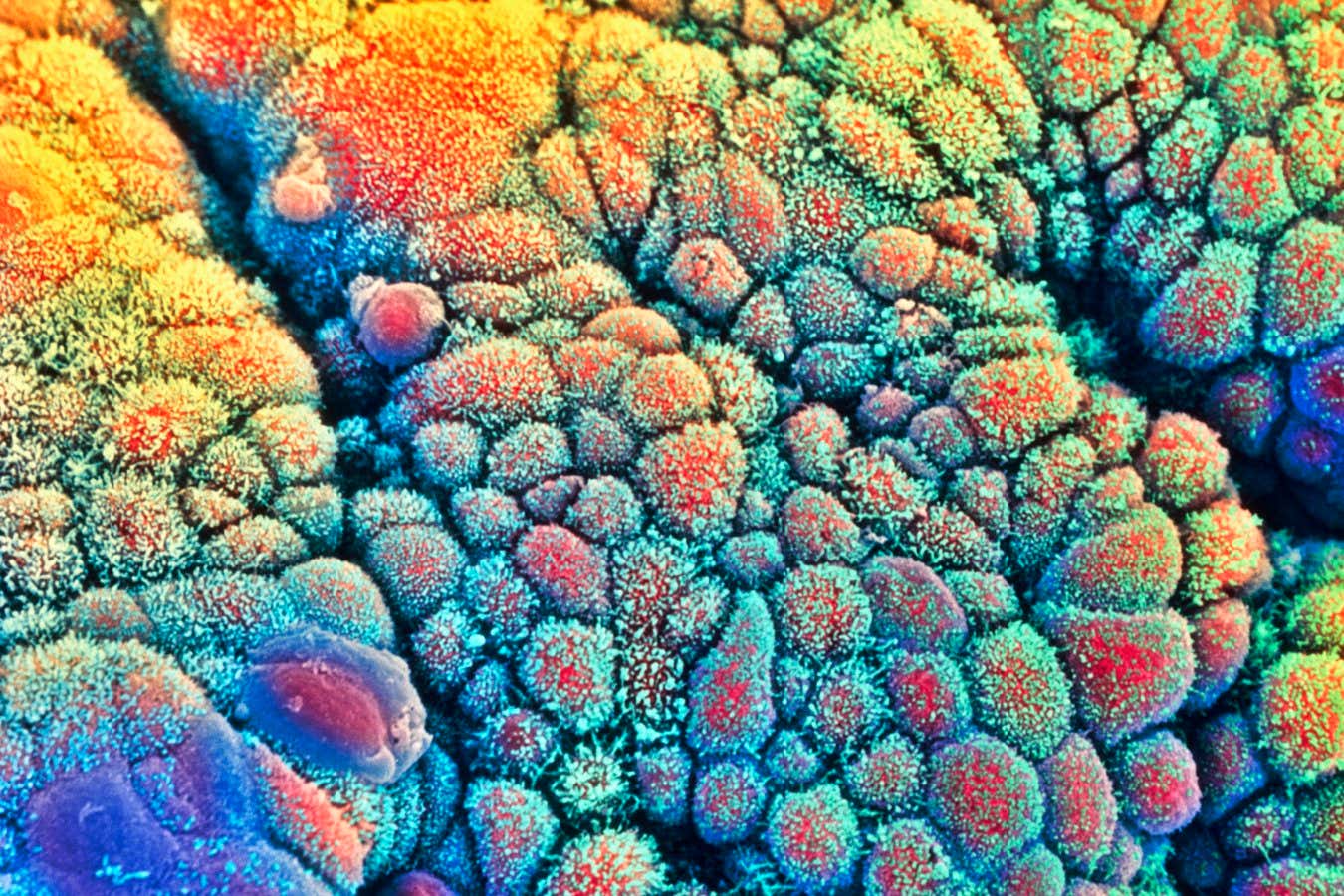 A scanning electron micrograph of cancer cells in the intestine