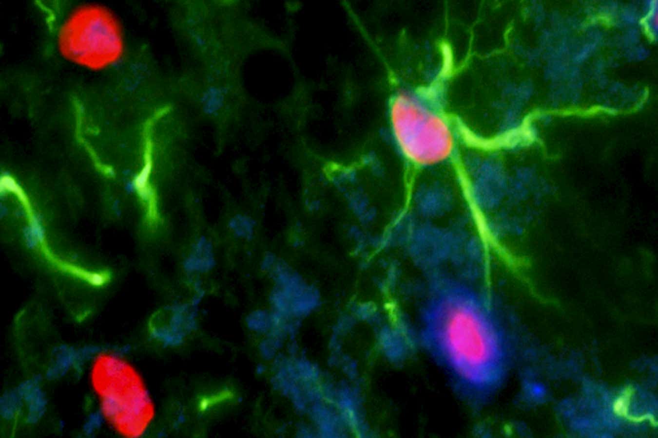 Nerve cell trauma response. Fluorescent light micrograph of a section through a spinal cord affected by multiple sclerosis (MS). Reactive glial stem cells are producing the protein GFAP (glial fibrillary acidic protein, green) and OLIG2 (oligodendrocyte lineage transcription factor 2, red) in an attempt to repair the damaged nerve cells. Cell nuclei are dyed blue. MS is an autoimmune condition, in which the immune system attacks nerve cells, impairing their ability to relay signals efficiently.