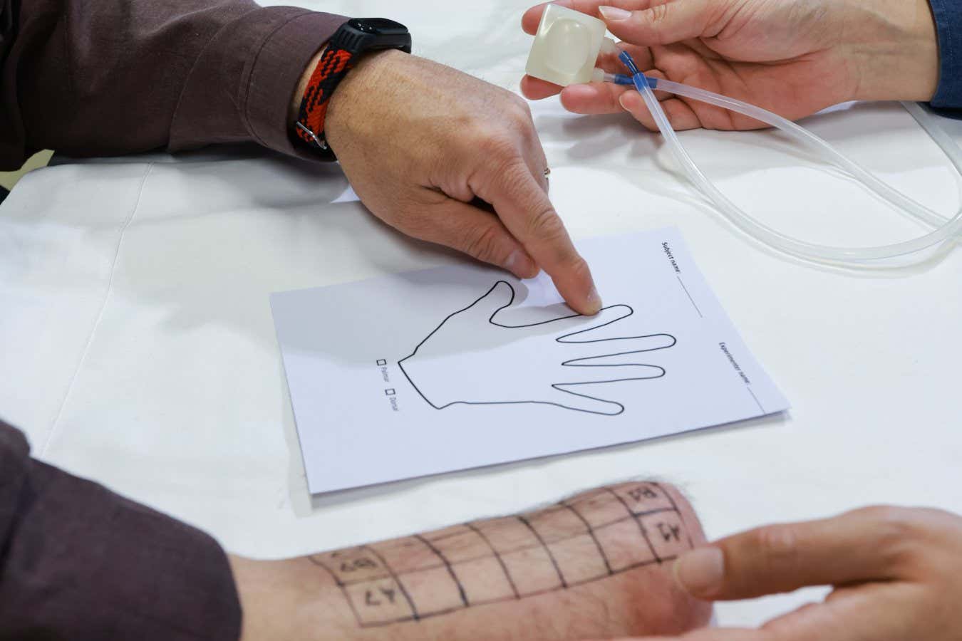 Someone with an amputated right arm showing where they are experiencing the feeling of temperature in their phantom hand