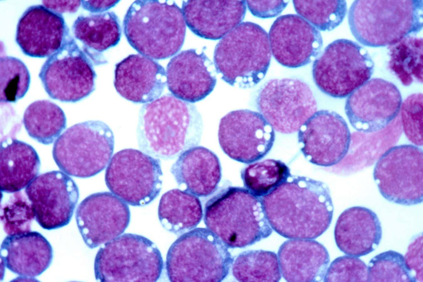 The Epstein Barr virus (EBV) can cause glandular fever, also known as infectious mononucleosis, and has been linked to conditions such as multiple sclerosis and some cancers