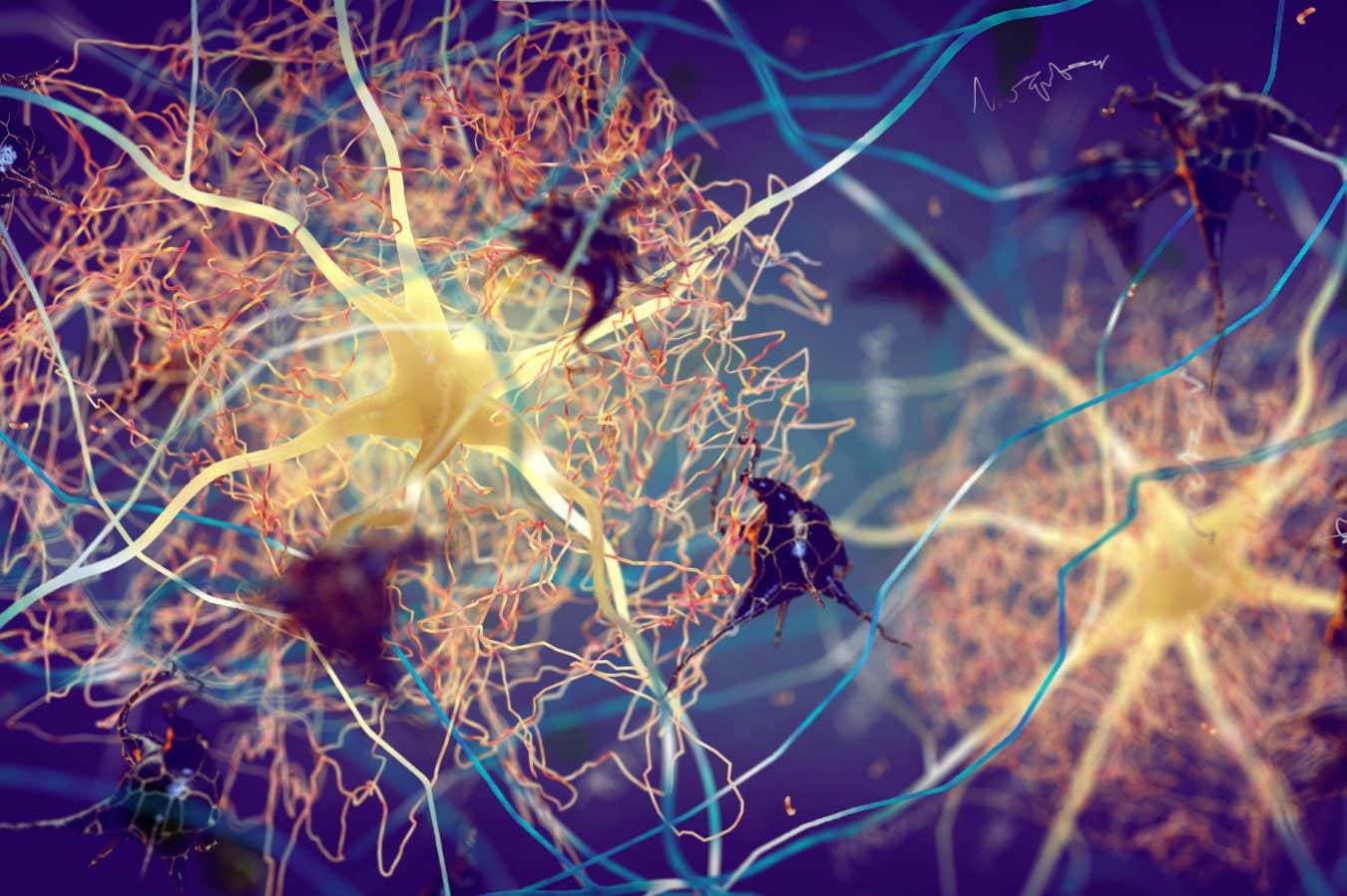 Amyloid plaques in the brain of someone with Alzheimer's disease. The condition has also been linked to too much cholesterol in brain cells, slowing brain signalling