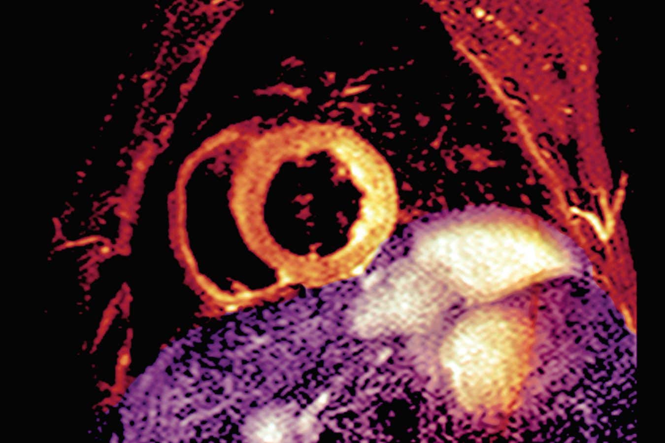 An MRI scan of a section through the chest and heart of someone who had a heart attack showing damage and swelling (yellow, centre)