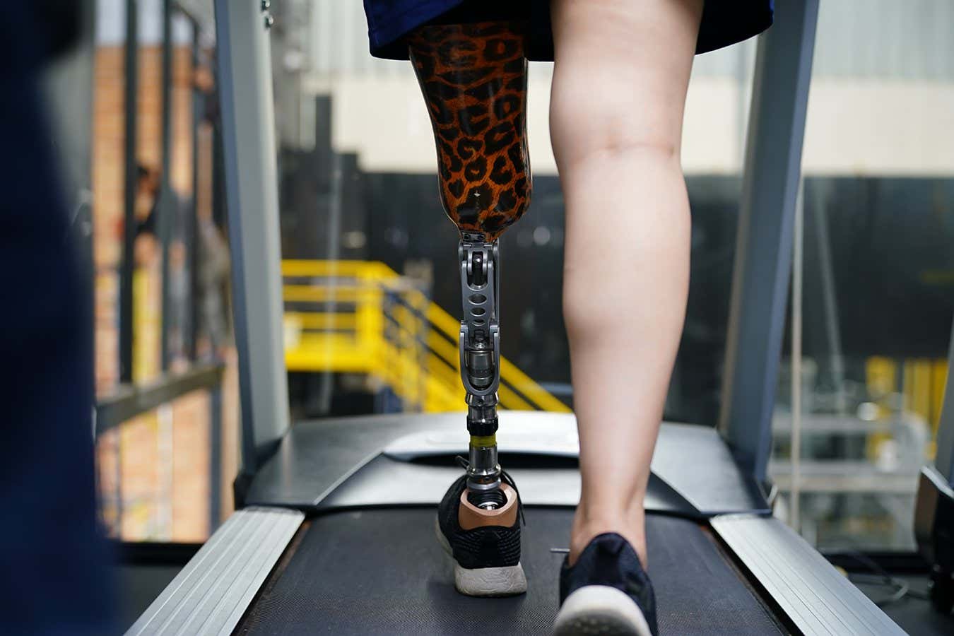 person with prosthetic limb