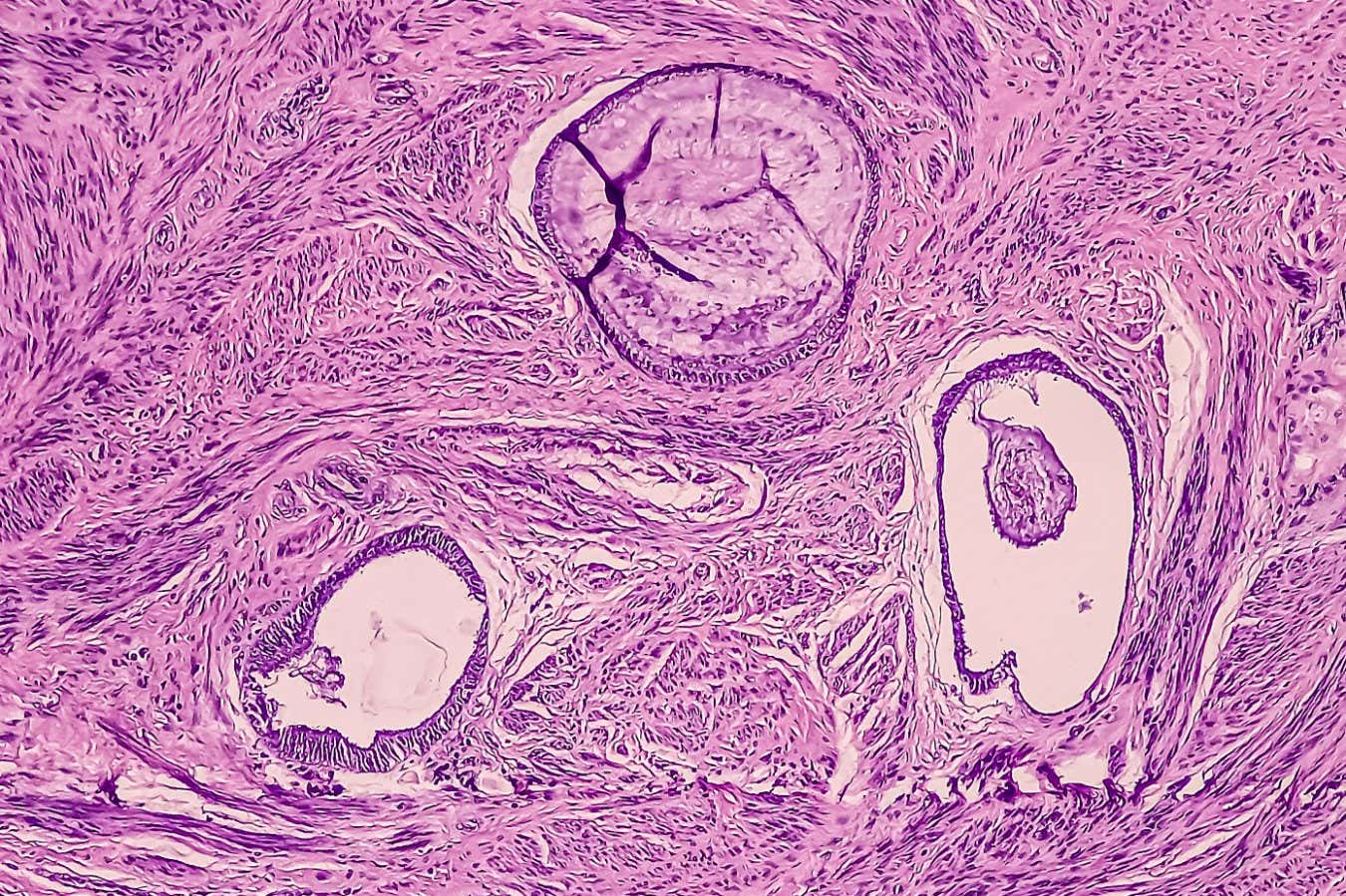An endometriosis cyst in tissue from the uterus