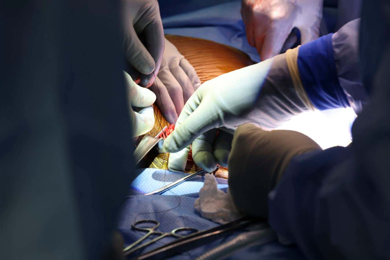 Drs. Kawai and Elias will be transplanting a genetically modified pig kidney