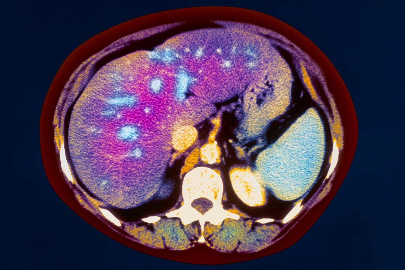 Fatty liver. Coloured computed tomography (CT) scan of an axial section through the abdomen of a 66 year old woman suffering from fatty liver. At lower centre is a bone of the vertebra (white). The liver is the large organ occupying much of the abdomen at upper left to right (purple). Fatty deposits in the liver show up as blue patches. The liver cells become swollen by large fat droplets. This condition occurs in heavy drinkers and alcoholics, where high levels of alcohol in the blood disturbs normal fat metabolism. Fatty deposits in the liver can also be caused by hypoxia, toxins or diabetes mellitus.