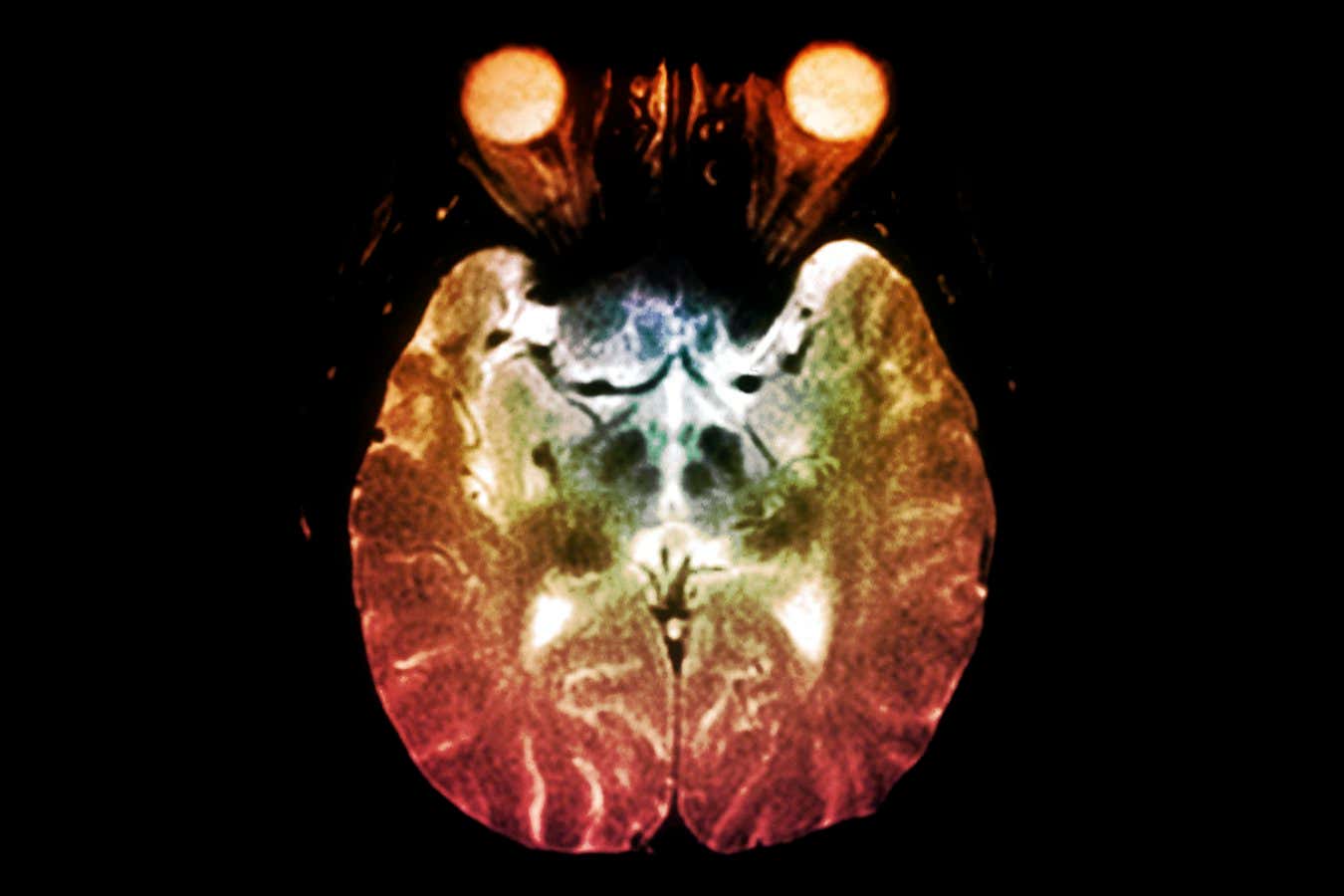 Magnetic resonance imaging scan showing plaques (dark areas) in the centre of the brain of someone with Parkinson's disease